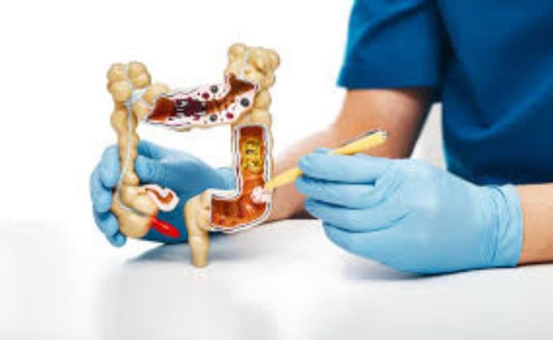 Avanços no diagnóstico e tratamento da diverticulite ganham destaque