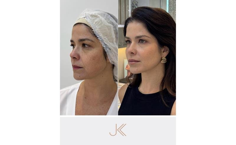 Samara Felippo aposta em protocolo de rejuvenescimento facial aliado ao tratamento de melasma na JK Estética Avançada